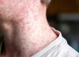 Nueva York declara emergencia por sarampión y Pensilvania supera los 1,000 casos
